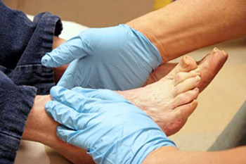 diabetic foot