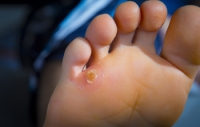 The Facts on Foot Corns