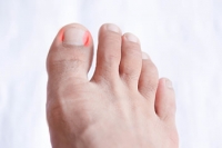 How Ingrown Toenails Occur