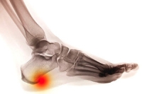 Common Types of Heel Spurs