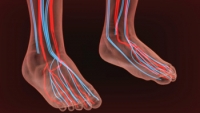 Varicose Veins in the Feet and Ankles