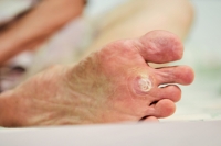 Differences Between Plantar Warts and Other Warts on the Feet