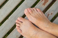 Do I Need Hammertoe Surgery?