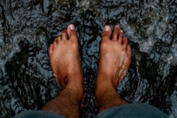 Hammertoe Surgery Risk Factors