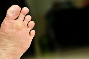 Plantar Warts or Corns?