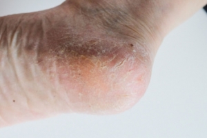 Causes and Prevention Tips for Cracked Heels