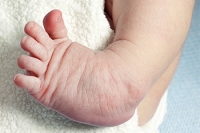 Clubfoot Is a Congenital Foot Deformity