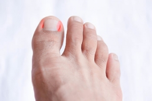 How Ingrown Toenails Occur