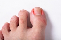 Causes of Ingrown Toenails