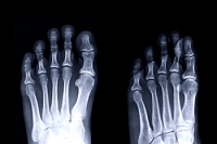How Stress Fractures Occur