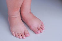 Pregnancy and Edema