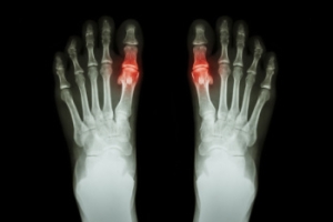 When Sudden Foot Pain Strikes