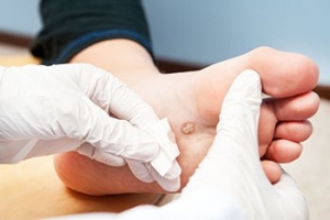 Plantar Warts 101
