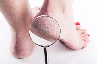 Why Do Cracked Heels Occur?