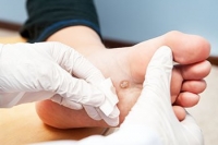 The Difference Between Plantar Warts and Common Warts