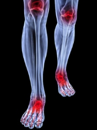 How to Care For Arthritic Feet