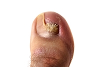 Need for Toenail Fungus Treatment