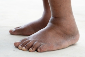 Why Are My Feet Swollen?
